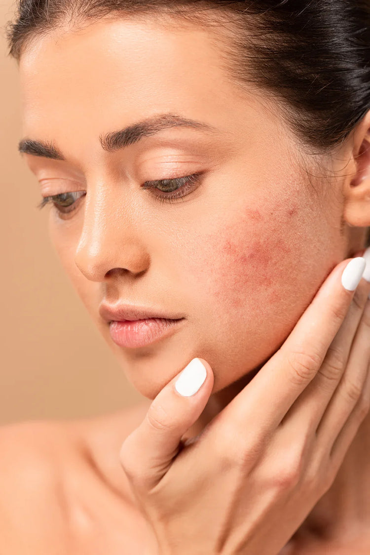Redness/Rosacea